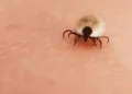 Check your bits: uptick in tick bites as season starts